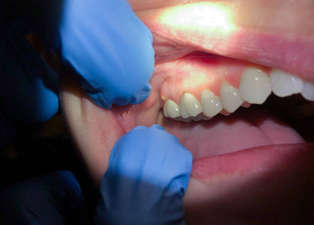 Best Emergency Treatment for Dental Infections or Abscesses in Salem, MA